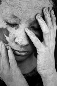 色素沈着を自宅で薄くするための効果的な方法は？